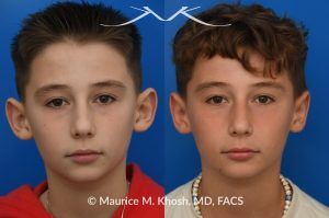 Photo of a patient before and after a procedure. Otoplasty - Otoplasty procedure, before and after photos.