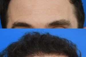 Photo of a patient before and after a procedure. FUE Hair Transplantation to Improve Frontal and Temporal Receding Hairline - photo before nad after procedure.