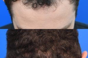 Photo of a patient before and after a procedure. FUE Hair Transplantation to Improve Frontal and Temporal Receding Hairline - photo before nad after procedure.