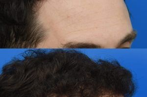 Photo of a patient before and after a procedure. FUE Hair Transplantation to Improve Frontal and Temporal Receding Hairline - photo before nad after procedure.