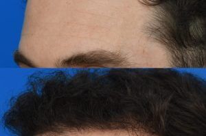 Photo of a patient before and after a procedure. FUE Hair Transplantation to Improve Frontal and Temporal Receding Hairline - photo before nad after procedure.