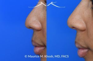 Photo of a patient before and after a procedure. Liquid rhinoplasty - photo before and after procedure.