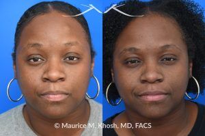 Photo of a patient before and after a procedure. Osteoma of Left Forehead - before-and-after composite photo.