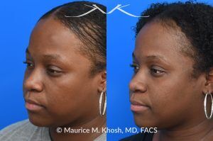 Photo of a patient before and after a procedure. Osteoma of Left Forehead - before-and-after composite photo.
