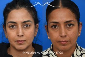 Photo of a patient before and after a procedure. Right-Sided Nasal Valve Repair - Repair using a bilayered spreader graft with a columellar strut to support the nasal tip.