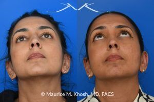 Photo of a patient before and after a procedure. Right-Sided Nasal Valve Repair - Repair using a bilayered spreader graft with a columellar strut to support the nasal tip.