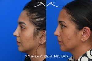 Photo of a patient before and after a procedure. Right-Sided Nasal Valve Repair - Repair using a bilayered spreader graft with a columellar strut to support the nasal tip.