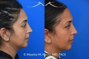 Photo of a patient before and after a procedure. Right-Sided Nasal Valve Repair - Repair using a bilayered spreader graft with a columellar strut to support the nasal tip.