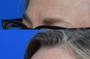 Photo of a patient before and after a procedure. Right Upper Forehead Osteoma - before-and-after composite photo.