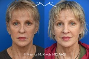 Photo of a patient before and after a procedure. Lip Lift - before and after photo showing enhanced shape and definition of the lips.