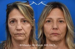 Photo of a patient before and after a procedure. Saddle Nose Reconstruction Using Autologous Rib Cartilage - Saddle nose nasal deformity due to large septum perforation and loss of bridge and tip support. The deformity was reconstructed utilizing the patient's own rib cartilage which was carved to recreate a natural nose that looks better and functions better.