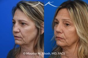 Photo of a patient before and after a procedure. Saddle Nose Reconstruction Using Autologous Rib Cartilage - Saddle nose nasal deformity due to large septum perforation and loss of bridge and tip support. The deformity was reconstructed utilizing the patient's own rib cartilage which was carved to recreate a natural nose that looks better and functions better.