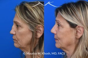 Photo of a patient before and after a procedure. Saddle Nose Reconstruction Using Autologous Rib Cartilage - Saddle nose nasal deformity due to large septum perforation and loss of bridge and tip support. The deformity was reconstructed utilizing the patient's own rib cartilage which was carved to recreate a natural nose that looks better and functions better.
