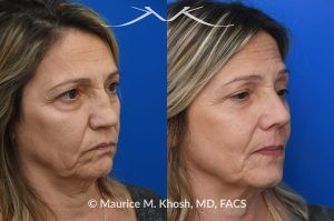 Photo of a patient before and after a procedure. Saddle Nose Reconstruction Using Autologous Rib Cartilage - Saddle nose nasal deformity due to large septum perforation and loss of bridge and tip support. The deformity was reconstructed utilizing the patient's own rib cartilage which was carved to recreate a natural nose that looks better and functions better.
