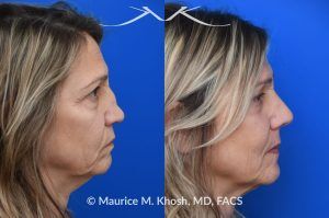 Photo of a patient before and after a procedure. Saddle Nose Reconstruction Using Autologous Rib Cartilage - Saddle nose nasal deformity due to large septum perforation and loss of bridge and tip support. The deformity was reconstructed utilizing the patient's own rib cartilage which was carved to recreate a natural nose that looks better and functions better.