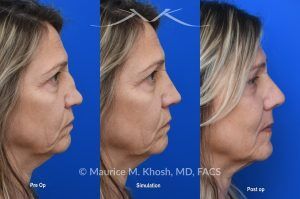 Photo of a patient before and after a procedure. Saddle Nose Reconstruction Using Autologous Rib Cartilage - Saddle nose nasal deformity due to large septum perforation and loss of bridge and tip support. The deformity was reconstructed utilizing the patient's own rib cartilage which was carved to recreate a natural nose that looks better and functions better.