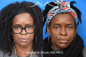 Photo of a patient before and after a procedure. Successful Osteoma Removal After Prior Attempt - This lovely patient sought consultation after a previous attempt to excise a large osteoma had been unsuccessful. We successfully removed the osteoma using a power drill, ensuring optimal results.