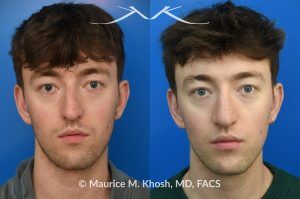 Photo of a patient before and after a procedure. Repair of Left Nasal Valve with Spreader Graft - This patient suffered a nasal fracture that resulted in the collapse of the left nasal valve. Reconstruction included a spreader graft on the right side and removal of the nasal hump. The surgery improved his breathing, enhanced nasal symmetry, and eliminated the bump on his nasal bridge.