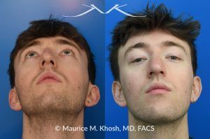 Photo of a patient before and after a procedure. Repair of Left Nasal Valve with Spreader Graft - This patient suffered a nasal fracture that resulted in the collapse of the left nasal valve. Reconstruction included a spreader graft on the right side and removal of the nasal hump. The surgery improved his breathing, enhanced nasal symmetry, and eliminated the bump on his nasal bridge.