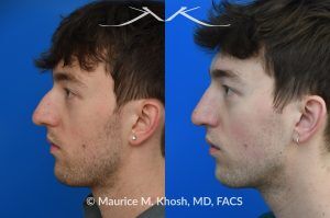Photo of a patient before and after a procedure. Repair of Left Nasal Valve with Spreader Graft - This patient suffered a nasal fracture that resulted in the collapse of the left nasal valve. Reconstruction included a spreader graft on the right side and removal of the nasal hump. The surgery improved his breathing, enhanced nasal symmetry, and eliminated the bump on his nasal bridge.