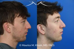 Photo of a patient before and after a procedure. Repair of Left Nasal Valve with Spreader Graft - This patient suffered a nasal fracture that resulted in the collapse of the left nasal valve. Reconstruction included a spreader graft on the right side and removal of the nasal hump. The surgery improved his breathing, enhanced nasal symmetry, and eliminated the bump on his nasal bridge.