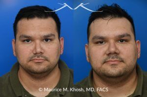 Photo of a patient before and after a procedure. Nasal Valve Repair with Rib Cartilage for Improved Breathing - This patient had previously undergone septoplasty to improve his breathing. However, he continued to experience obstruction, especially during sleep or exercise. Nasal valve repair using his own rib cartilage successfully restored his breathing.
