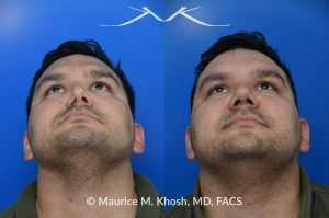 Photo of a patient before and after a procedure. Nasal Valve Repair with Rib Cartilage for Improved Breathing - This patient had previously undergone septoplasty to improve his breathing. However, he continued to experience obstruction, especially during sleep or exercise. Nasal valve repair using his own rib cartilage successfully restored his breathing.