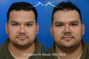 Photo of a patient before and after a procedure. Nasal Valve Repair with Rib Cartilage for Improved Breathing - This patient had previously undergone septoplasty to improve his breathing. However, he continued to experience obstruction, especially during sleep or exercise. Nasal valve repair using his own rib cartilage successfully restored his breathing.