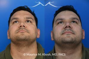 Photo of a patient before and after a procedure. Nasal Valve Repair with Rib Cartilage for Improved Breathing - This patient had previously undergone septoplasty to improve his breathing. However, he continued to experience obstruction, especially during sleep or exercise. Nasal valve repair using his own rib cartilage successfully restored his breathing.
