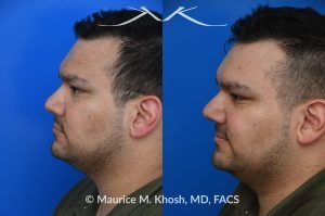 Photo of a patient before and after a procedure. Nasal Valve Repair with Rib Cartilage for Improved Breathing - This patient had previously undergone septoplasty to improve his breathing. However, he continued to experience obstruction, especially during sleep or exercise. Nasal valve repair using his own rib cartilage successfully restored his breathing.