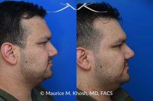 Photo of a patient before and after a procedure. Nasal Valve Repair with Rib Cartilage for Improved Breathing - This patient had previously undergone septoplasty to improve his breathing. However, he continued to experience obstruction, especially during sleep or exercise. Nasal valve repair using his own rib cartilage successfully restored his breathing.