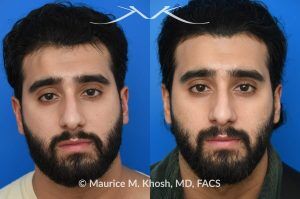 Photo of a patient before and after a procedure. Large Osteoma Removal Under Local Anesthesia - This large osteoma was successfully removed under local anesthesia using a power drill. The patient is ecstatic about his results. 