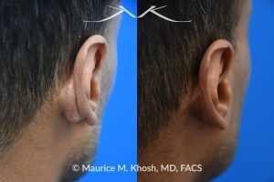 Photo of a patient before and after a procedure. Post-Otoplasty Keloid Repair - This procedure involved the repair of a post-auricular keloid that developed after a previous otoplasty surgery. The treatment aimed to reduce the keloid's size and improve the appearance and comfort of the ear area.