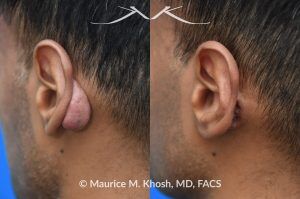 Photo of a patient before and after a procedure. Post-Otoplasty Keloid Repair - This procedure involved the repair of a post-auricular keloid that developed after a previous otoplasty surgery. The treatment aimed to reduce the keloid's size and improve the appearance and comfort of the ear area.
