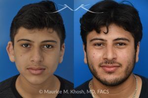 Photo of a patient before and after a procedure. 10 Years After Teenage Otoplasty for Right Ear Reshaping - Shown here are the long-term results—10 years after right ear reshaping surgery (otoplasty) performed during the patient’s teenage years. The improved symmetry provided both aesthetic balance and increased self-confidence.