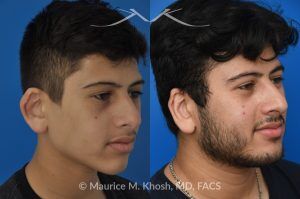 Photo of a patient before and after a procedure. 10 Years After Teenage Otoplasty for Right Ear Reshaping - Shown here are the long-term results—10 years after right ear reshaping surgery (otoplasty) performed during the patient’s teenage years. The improved symmetry provided both aesthetic balance and increased self-confidence.