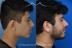 Photo of a patient before and after a procedure. 10 Years After Teenage Otoplasty for Right Ear Reshaping - Shown here are the long-term results—10 years after right ear reshaping surgery (otoplasty) performed during the patient’s teenage years. The improved symmetry provided both aesthetic balance and increased self-confidence.