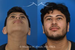 Photo of a patient before and after a procedure. 10 Years After Teenage Otoplasty for Right Ear Reshaping - Shown here are the long-term results—10 years after right ear reshaping surgery (otoplasty) performed during the patient’s teenage years. The improved symmetry provided both aesthetic balance and increased self-confidence.