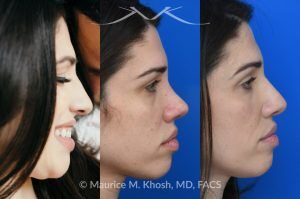 Photo of a patient before and after a procedure. Revision rhinoplasty for nasal dorsum and tip correction - This revision rhinoplasty addressed over-resection of the nasal dorsum and over-rotation of the tip using ear cartilage and Alloderm.