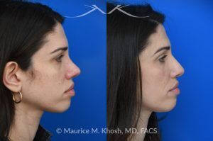 Photo of a patient before and after a procedure. Revision rhinoplasty for nasal dorsum and tip correction - This revision rhinoplasty addressed over-resection of the nasal dorsum and over-rotation of the tip using ear cartilage and Alloderm.