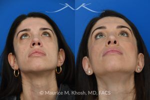 Photo of a patient before and after a procedure. Revision rhinoplasty for nasal dorsum and tip correction - This revision rhinoplasty addressed over-resection of the nasal dorsum and over-rotation of the tip using ear cartilage and Alloderm.