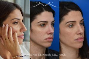 Photo of a patient before and after a procedure. Revision rhinoplasty for nasal dorsum and tip correction - This revision rhinoplasty addressed over-resection of the nasal dorsum and over-rotation of the tip using ear cartilage and Alloderm.