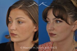 Photo of a patient before and after a procedure. Saddle Nose Reconstruction Using Rib Cartilage - 27 year old with saddle nose collapse due to an autoimmune condition. She was bothered by the unnatural sag of the bridge of the nose, loss of nasal tip definition, and nasal obstruction. Her own rib cartilage was used during saddle nose rhinoplasty, to reconstruct the nose and restore breathing. The last two images show the computer simulation of surgical outcome (middle picture), as well as the final outcome (the picture on the right side). Patient is delighted with her results. 
