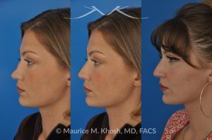 Photo of a patient before and after a procedure. Saddle Nose Reconstruction Using Rib Cartilage - 27 year old with saddle nose collapse due to an autoimmune condition. She was bothered by the unnatural sag of the bridge of the nose, loss of nasal tip definition, and nasal obstruction. Her own rib cartilage was used during saddle nose rhinoplasty, to reconstruct the nose and restore breathing. The last two images show the computer simulation of surgical outcome (middle picture), as well as the final outcome (the picture on the right side). Patient is delighted with her results. 