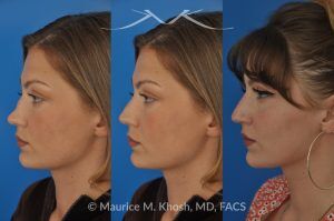 Photo of a patient before and after a procedure. Saddle Nose Reconstruction Using Rib Cartilage - 27 year old with saddle nose collapse due to an autoimmune condition. She was bothered by the unnatural sag of the bridge of the nose, loss of nasal tip definition, and nasal obstruction. Her own rib cartilage was used during saddle nose rhinoplasty, to reconstruct the nose and restore breathing. The last two images show the computer simulation of surgical outcome (middle picture), as well as the final outcome (the picture on the right side). Patient is delighted with her results. 