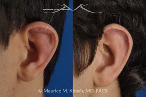 Photo of a patient before and after a procedure. Auricular Hematoma Drainage - Drainage of ear blood collection, auricular hematoma.