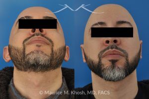 Photo of a patient before and after a procedure. Ear Pinning (Otoplasty) - Cosmetic ear surgery performed to correct prominent or protruding ears by repositioning them closer to the head for a more natural contour.