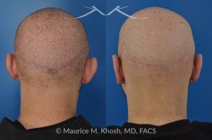 Photo of a patient before and after a procedure. Ear Pinning (Otoplasty) - Cosmetic ear surgery performed to correct prominent or protruding ears by repositioning them closer to the head for a more natural contour.