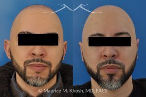 Photo of a patient before and after a procedure. Ear Pinning (Otoplasty) - Cosmetic ear surgery performed to correct prominent or protruding ears by repositioning them closer to the head for a more natural contour.