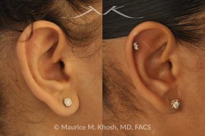 Photo of a patient before and after a procedure. Earlobe Reduction Surgery - Otoplasty procedure to shorten and reshape elongated, hanging earlobes for a more balanced and natural appearance.